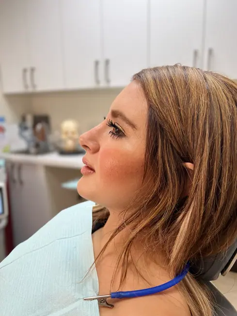 Facial Balancing with Fillers