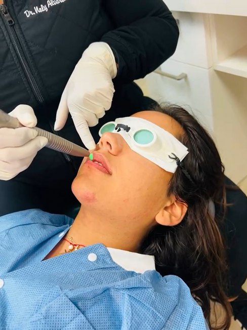 Laser Lip Enhancement