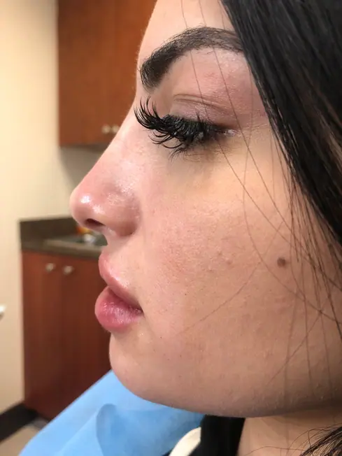 Lip Fillers Dr. Noly Alvarez