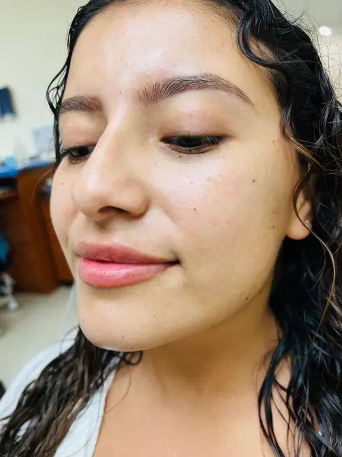 Nose Lips Filler Dr. Noly Alvarez