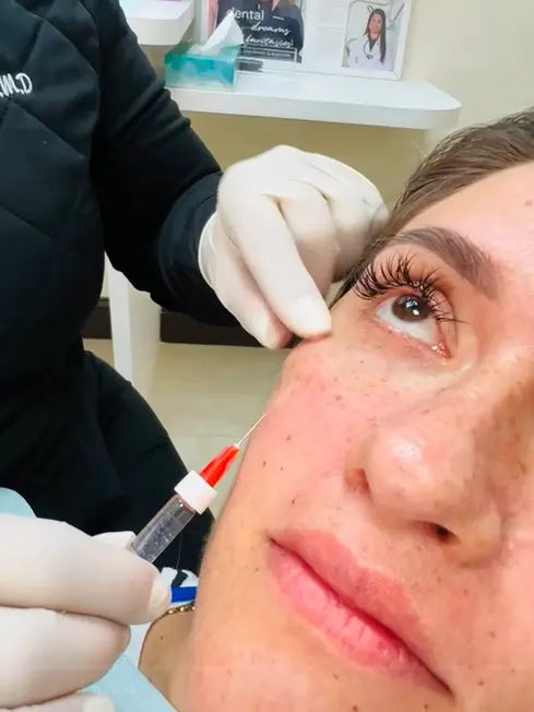 Under Eyes Filler